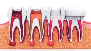 Imagen del servicio de Endodoncia